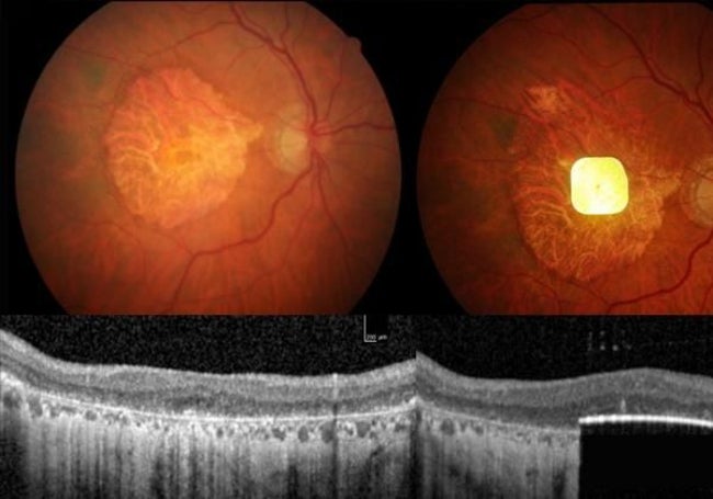 El chip implantado en el ojo.